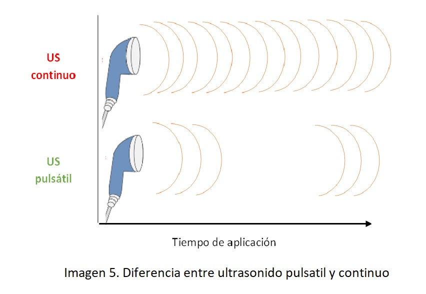 Diferencia gráfica entre US pulsátil y continuo